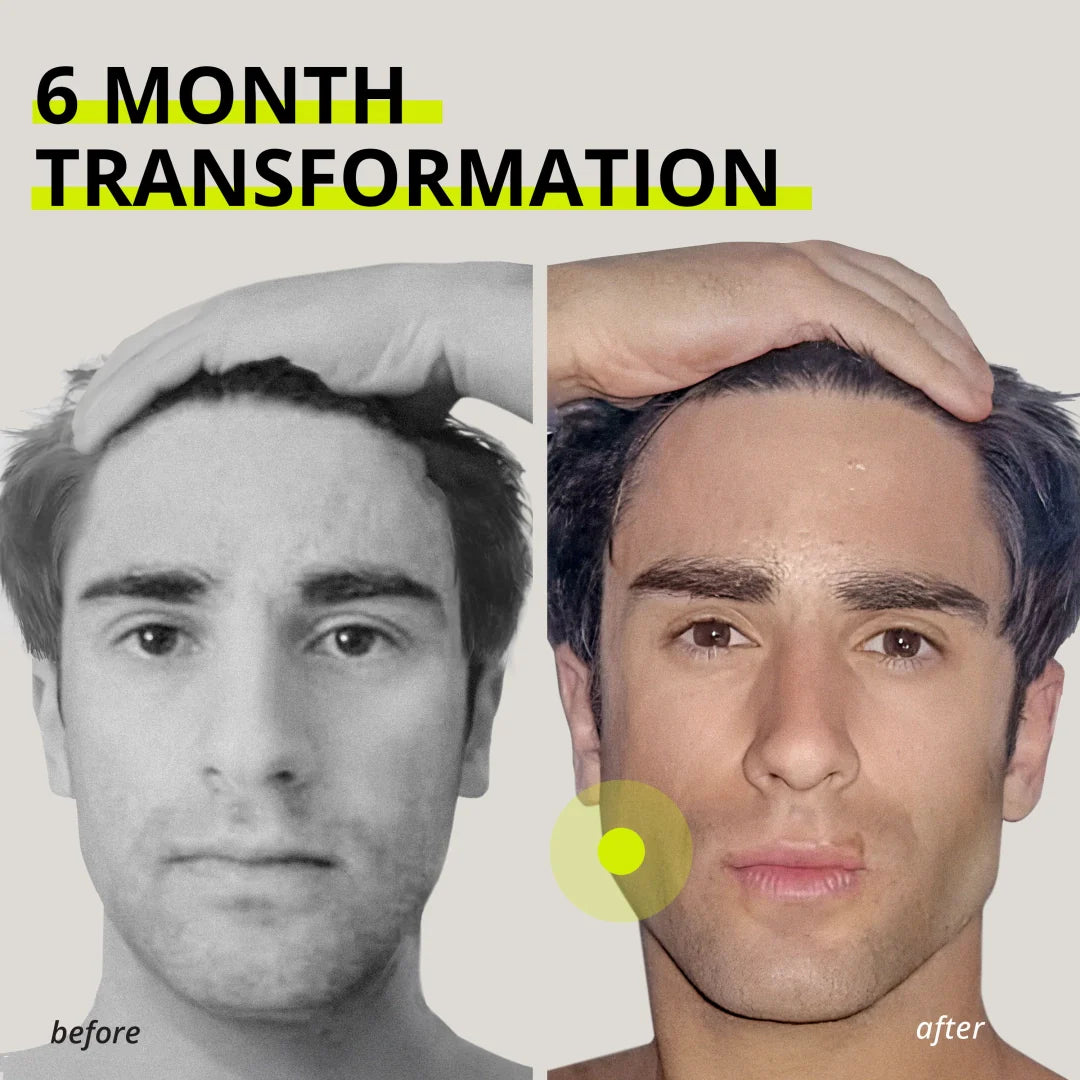 Ejercitadores de Mandíbula - Pack 2× JawFlex Pro